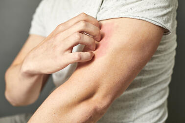 The main symptom of scabies is very intense itching. Photo: Adobe Stock